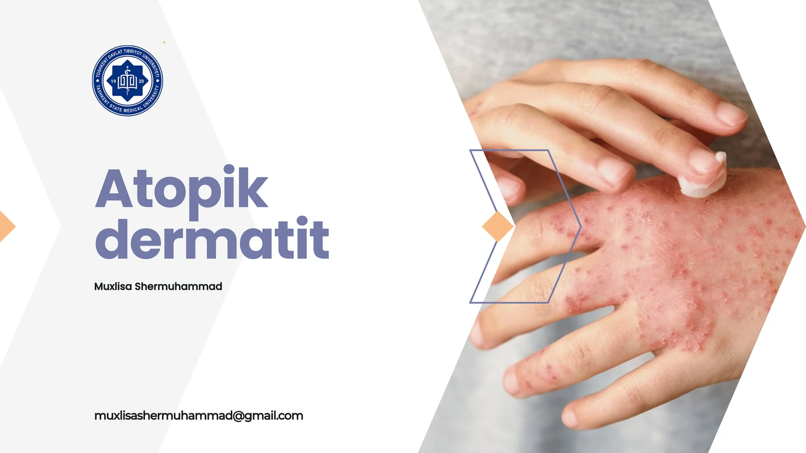 Atopik dermatit
